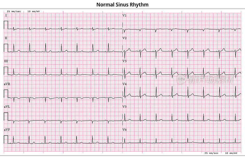 心电图正常窦性心律- 12导联心电图常见病例- 6秒/导联